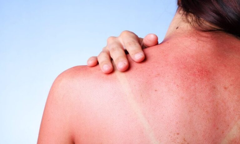 Trusted Walk-In Sunburn Clinic Services In Southfield MI