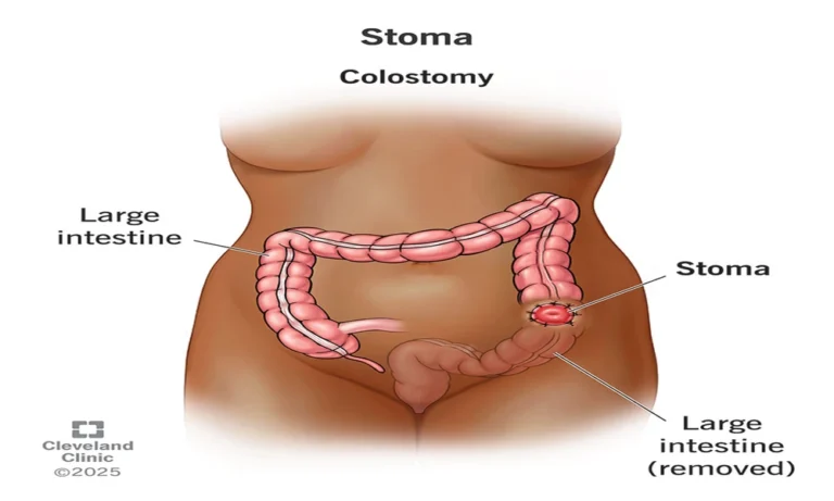 Why Trying A Stoma Bag Before Committing To A Styles Makes A Big Difference