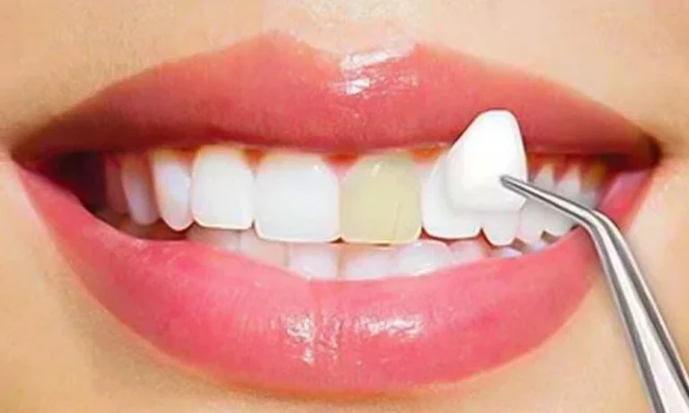 Treating “Gummy Smiles” With Periodontic Techniques